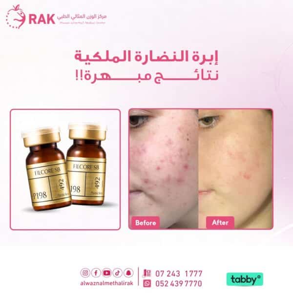 ابرة الاكسوزوم jpg1111111 600x600