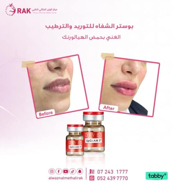 بوستر الشفاه 1 600x600
